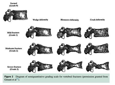 compression test fracture|grades of compression fracture.